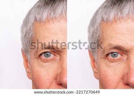 Cropped shot of a elderly caucasian man's face with drooping upper eyelid before and after blepharoplasty isolated on white background. Result of plastic surgery. Changing the shape, cut of the eyes