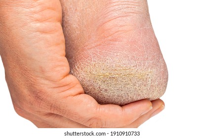 Cropped shot of a female heel with hardened skin with white background