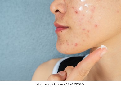 Cropped Shot Of Woman Half Face With Acne Inflammation (Papule And Pustule) On Her Face And She Applying Acne Cream On Her Face For Treat. Conceptual Of Problems On Woman Skin.