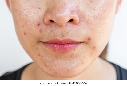Cropped shot of woman having problems of acne inflamed on her face. Inflamed acne consists of swelling, redness, and pores that are deeply clogged with bacteria, oil, and dead skin cells.