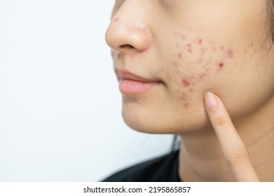 Cropped Shot Of Woman Pointing To An Acne Problem On Her Cheek. Inflamed Acne Consists Of Swelling, Redness, And Pores That Are Deeply Clogged With Bacteria, Oil, And Dead Skin Cells.