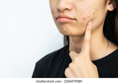 Cropped Shot Of Woman Pointing To An Acne Problem On Her Cheek. Inflamed Acne Consists Of Swelling, Redness, And Pores That Are Deeply Clogged With Bacteria, Oil, And Dead Skin Cells.