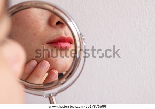Cropped shot of woman worry\
about her face when she saw the problem of acne occur on her chin\
by a mini mirror. Conceptual shot of Acne and problem skin on\
female face.