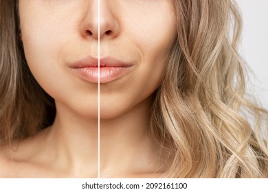 Cropped shot of young caucasian blonde woman with wavy hair before and after plastic surgery buccal fat pad removal. A lower part of face with clear highlighted cheekbones. Result of cosmetic surgery