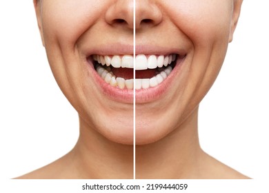 Cropped shot of a young caucasian smiling woman before and after veneers installation isolated on a white background. Teeth whitening. Dentistry, dental treatment. Comparison of the shape of teeth