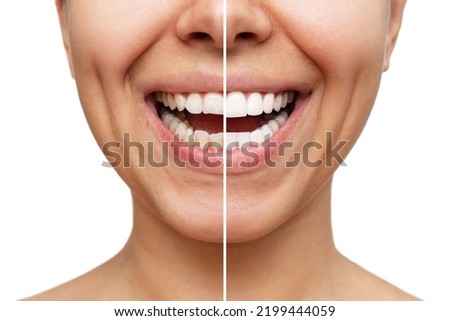 Cropped shot of a young caucasian smiling woman before and after veneers installation isolated on a white background. Teeth whitening. Dentistry, dental treatment. Comparison of the shape of teeth