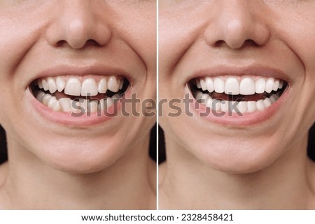Cropped shot of a young caucasian smiling woman before and after veneers installation. Teeth whitening. Dentistry, dental treatment. Сorrection of uneven teeth with braces Сток-фото © 