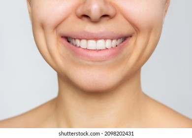 Cropped Shot Of A Young Caucasian Woman With Perfect White Even Teeth Isolated On A White Background. Oral Hygiene, Dental Health Care. Close-up Of Beautiful Smile, Dimples On The Cheeks. Dentistry