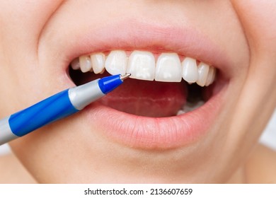 Cropped Shot Of A Young Caucasian Woman Pointing To White Spots On The Tooth Enamel With A Pen. Oral Hygiene, Dental Health Care. Dentistry, Demineralization Of Teeth, Enamel Hypoplasia, Fluorosis