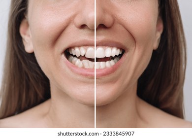 Cropped shot of a young caucasian woman before and after veneers installation. Teeth whitening. Dentistry, dental treatment. Сorrection of uneven teeth with braces. Comparison, difference - Shutterstock ID 2333845907