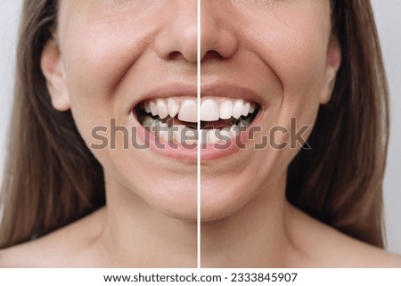 Cropped shot of a young caucasian woman before and after veneers installation. Teeth whitening. Dentistry, dental treatment. Сorrection of uneven teeth with braces. Comparison, difference