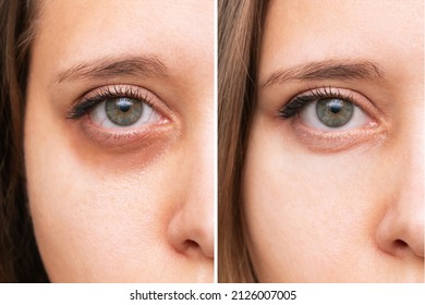 Cropped shot of a young caucasian woman's face with dark circles under eyes before and after cosmetic treatment. Bruises under the eyes caused by fatigue, insomnia. The result of therapy - Shutterstock ID 2126007005