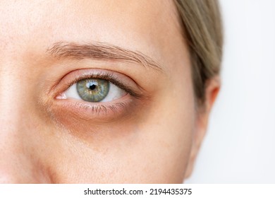 Cropped Shot Of A Young Caucasian Woman's Face With Dark Circle Under Eye Isolated On A White Background. Pale Skin, Bruises Under Eyes. Insomnia, Stress