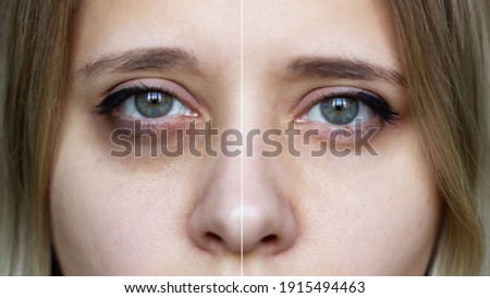 Cropped shot of a young female face with makeup. Female green eyes with bruises under eyes before and after cosmetic treatment. Dark circles under the eyes