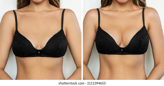 Cropped shot of young tanned woman in bra before and after breast augmentation with silicone implants. The result of a breast lift. Breast size correction on white background. Plastic surgery concept