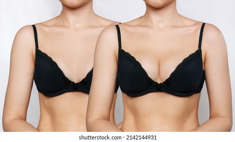 Cropped shot of young tanned woman in bra before and after breast augmentation with silicone implants. The result of a breast lift. Breast size correction on gray background. Plastic surgery concept