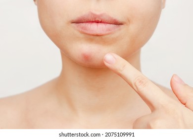 Cropped shot of a young woman pointing to a red inflamed pimple on her chin isolated on a white background. The problem of acne on female face. Problem skin, care and beauty. Dermatology, cosmetology