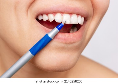 Cropped shot of a young woman pointing to white spots on the tooth enamel with a pen. Oral hygiene, dental health care. Dentistry, demineralization of teeth, enamel hypoplasia, fluorosis
