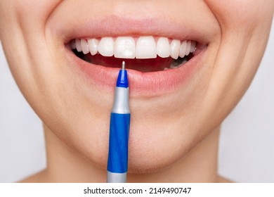 Cropped Shot Of A Young Woman Pointing To White Spot On The Tooth Enamel With A Pen. Oral Hygiene, Dental Health Care. Dentistry, Demineralization Of Teeth, Enamel Hypoplasia, Pathology, Fluorosis