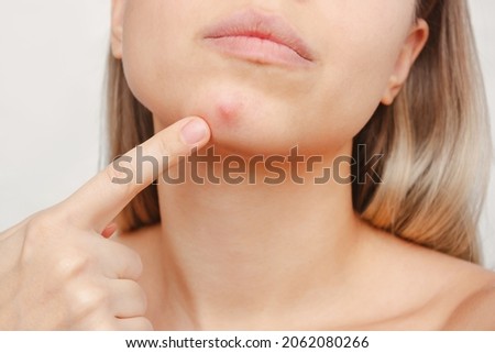 Cropped shot of a young woman pointing to a red inflamed pimple on her chin on a white background. The problem of acne on female face. Problem skin, care and beauty concept. Dermatology, cosmetology