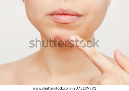 Cropped shot of a young woman pointing to a red inflamed pimple on her chin isolated on a white background. The problem of acne on female face. Problem skin, care and beauty. Dermatology, cosmetology