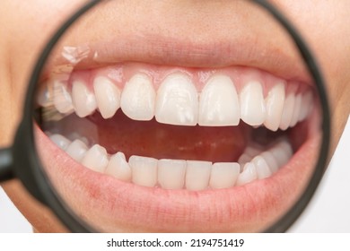 Cropped Shot Of A Young Woman With White Spot On The Tooth Enamel Enlarged In Magnifying Glass. Oral Hygiene, Dental Care. Dentistry, Demineralization Of Teeth, Enamel Hypoplasia, Pathology, Fluorosis