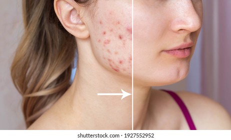 Cropped shot of a young woman's face before and after acne  treatment on face. Pimples, red scars on the cheeks and chin of the girl. Problem skin, care and beauty concept. Cosmetology, dermatology