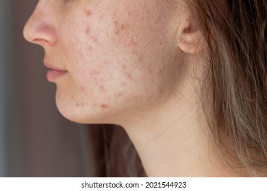 Cropped shot of a young woman's face in profile with problem of acne. Pimples, red scars on cheeks and chin. Allergies, dermatitis, rash. Problem skin, care and beauty concept.Dermatology, cosmetology