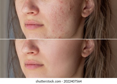 Cropped shot of a young woman's face before and after acne treatment on face. Pimples, red scars, rash on cheeks and chin. Allergies, dermatitis, bad nutrition. Problem skin, care and beauty concept