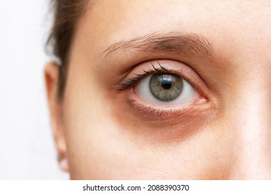 Cropped shot of a young woman's face with dark circle under eye isolated on a white background. Bruise under the eyes are caused by fatigue, nervousness, lack of sleep, insomnia and stress