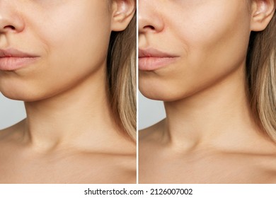 Cropped shot of young woman's face before and after plastic surgery buccal fat pad removal. A lower part of face with clear highlighted cheekbones. Result of cosmetic surgery - Shutterstock ID 2126007002