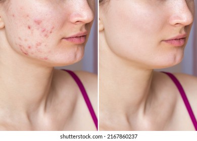 Cropped shot of young woman's face before and after acne treatment on face. Pimples, red scars on the cheeks and chin of a girl. Problem skin, health care and beauty concept. Dermatology, cosmetology