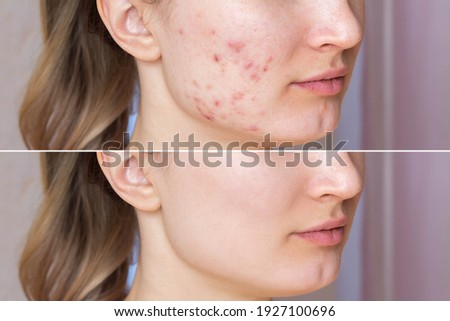 Cropped shot of a young woman's face before and after acne  treatment on face. Pimples, red scars on the cheeks and chin of the girl. Problem skin, care and beauty concept. Dermatology, cosmetology