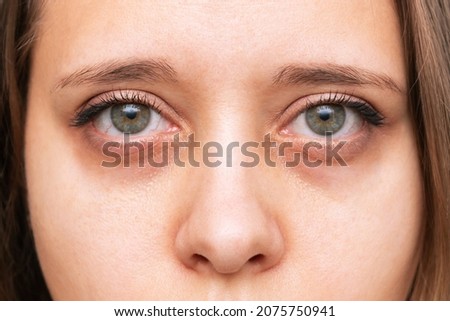 Cropped shot of a young woman's face. Green eyes with dark circles under eyes with red capillaries. Bruises under the eyes are caused by fatigue, nervousness, lack of sleep, insomnia and stress