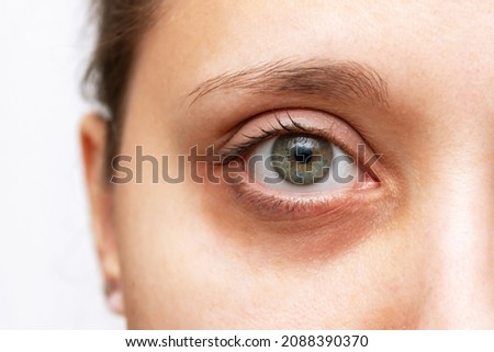 Cropped shot of a young woman's face with dark circle under eye isolated on a white background. Bruise under the eyes are caused by fatigue, nervousness, lack of sleep, insomnia and stress