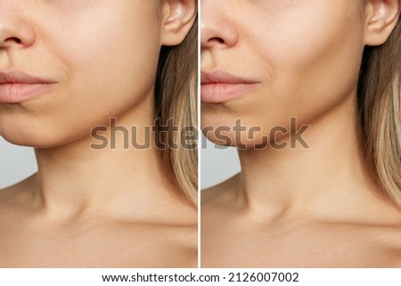 Cropped shot of young woman's face before and after plastic surgery buccal fat pad removal. A lower part of face with clear highlighted cheekbones. Result of cosmetic surgery