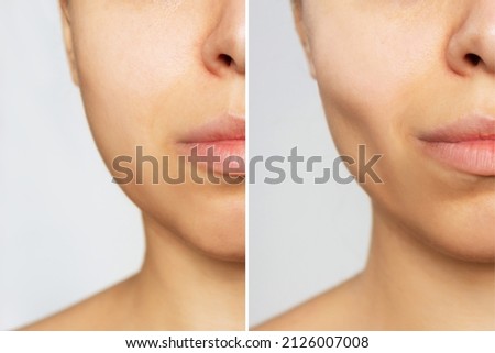 Cropped shot of young woman's face before and after plastic surgery buccal fat pad removal on a white background. A lower part of face with clear highlighted cheekbones. Result of cosmetic surgery