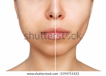 Cropped shot of young woman's face before and after plastic surgery buccal fat pad removal on a white background. A lower part of face with clear highlighted cheekbones. Result of surgery, comparison