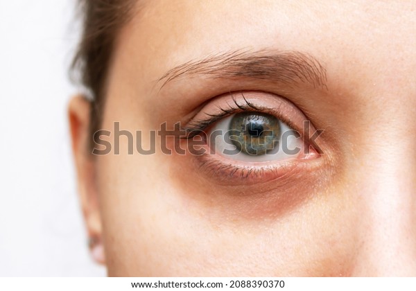 Cropped\
shot of a young woman\'s face with dark circle under eye isolated on\
a white background. Bruise under the eyes are caused by fatigue,\
nervousness, lack of sleep, insomnia and\
stress