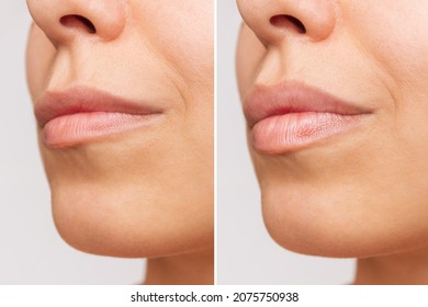 Cropped shot of young women's face with lips before and after lip enhancement on a gray background. Injection of filler in lips. Lip augmentation