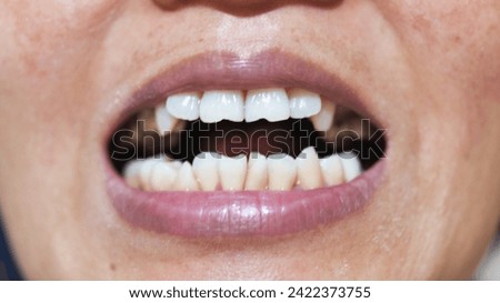 The crowded condition of a woman's teeth. Requires orthodontic treatment so that the teeth are straight.