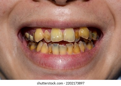 Crowded Teeth With Yellow Colored Stains. Poor Oral Hygiene.