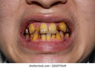 Crowded Teeth With Yellow Colored Tobacco Stains. Poor Oral Hygiene.