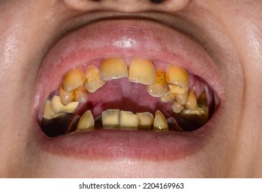 Crowded Teeth With Yellow Colored Tobacco Stains. Poor Oral Hygiene.