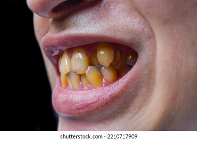 Crowded Teeth With Yellow Colored Tobacco Stains. Poor Oral Hygiene.