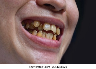 Crowded Teeth With Yellow Colored Tobacco Stains. Poor Oral Hygiene.