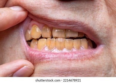 Crowded Teeth With Yellow Colored Tobacco Stains. Poor Oral Hygiene.