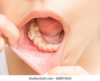 Crowding teeth. malocclusion teeth. In the mouth of this child with permanent teeth up insert the milk teeth that have not dropped. - Shutterstock ID 608073635