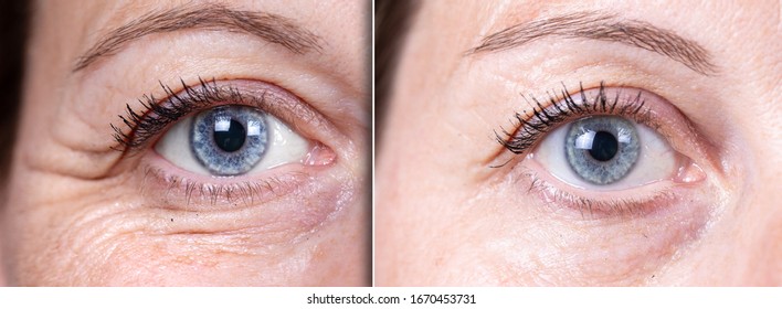 Crow's feet before and after beauty care comparison. Wrinkles removing. Closeup view of aged caucasian women eyes. 
