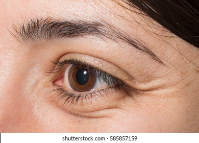 Crow's Feet And Wrinkles In Eye